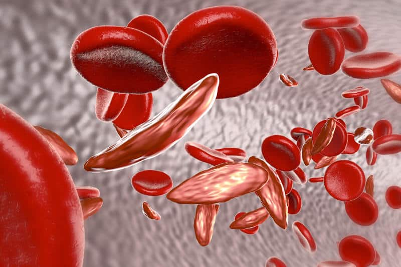 сърповидно-клетъчна анемия